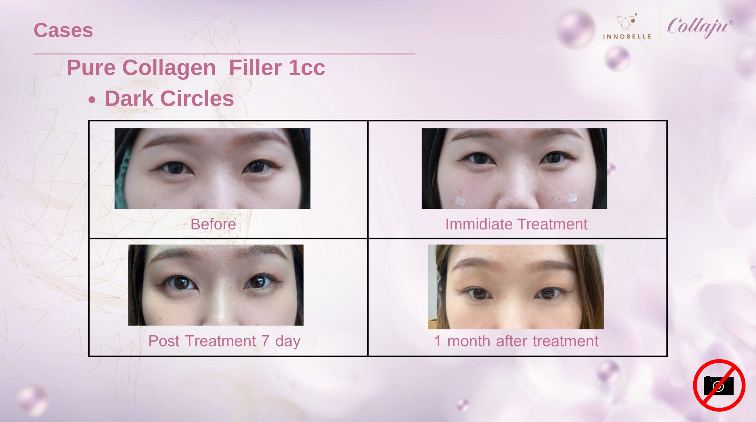 Dark Circles Before After