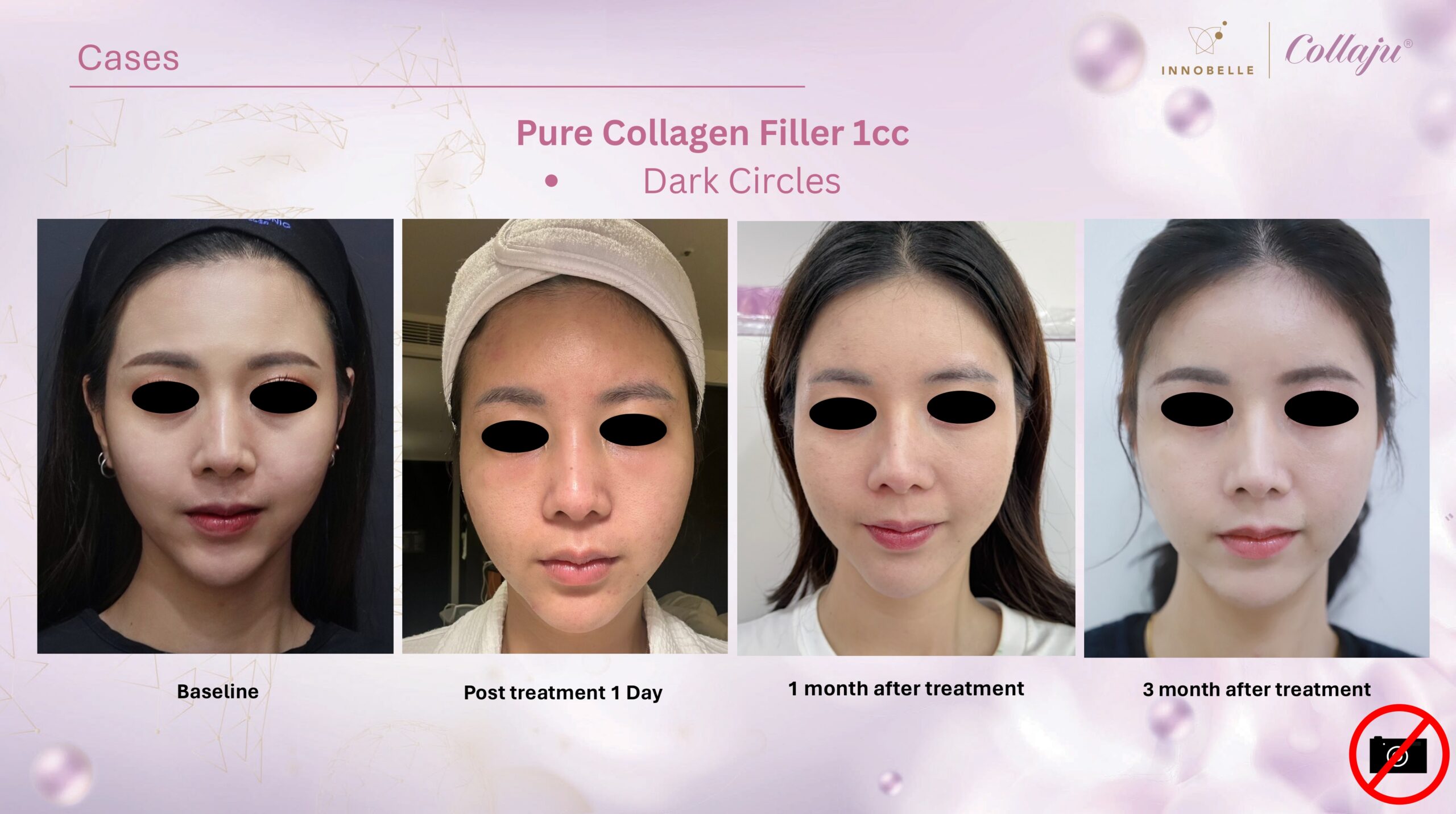 Dark Circles Full Face Before After