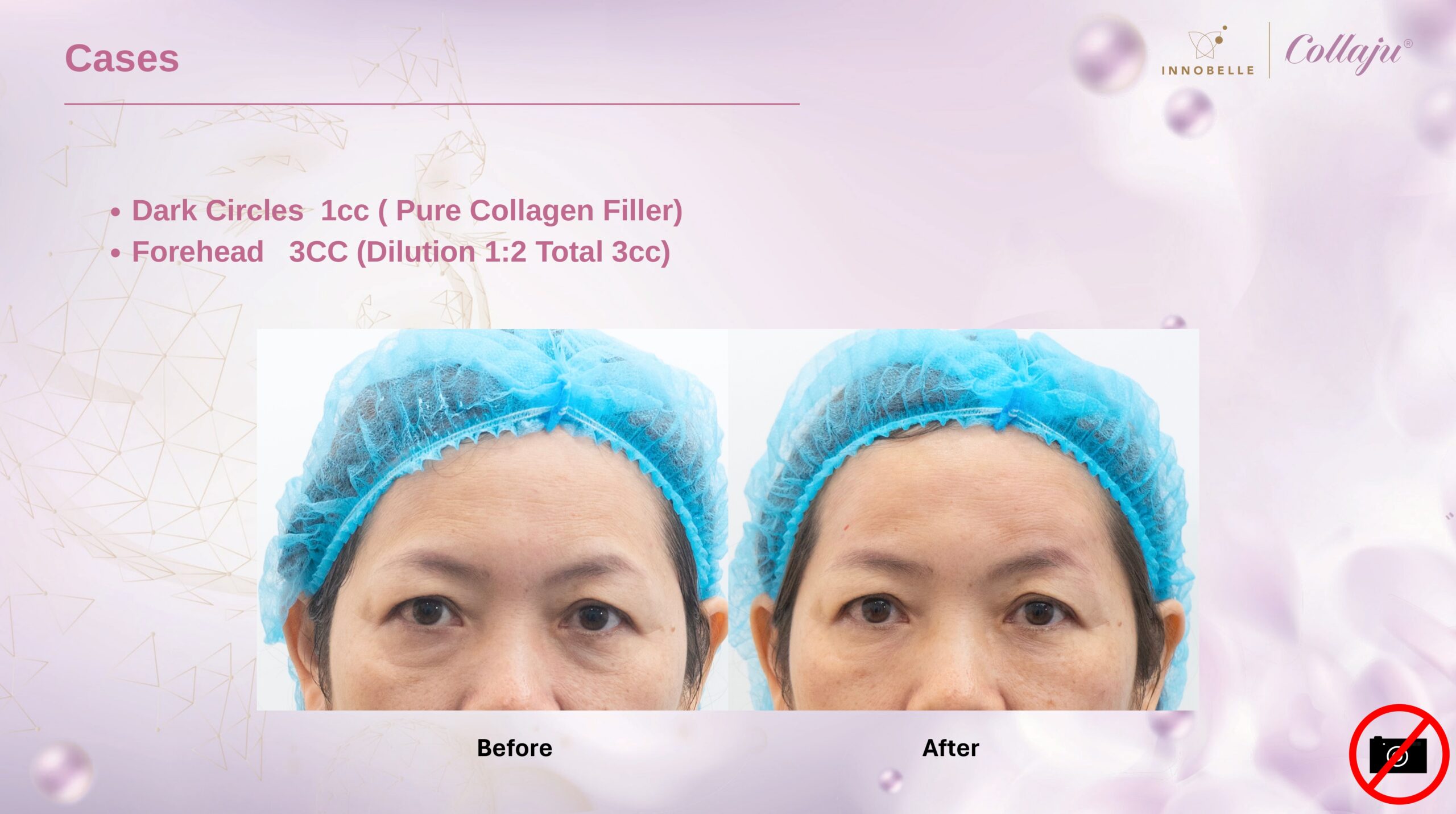 Forehead Volume Before After 2 Weeks