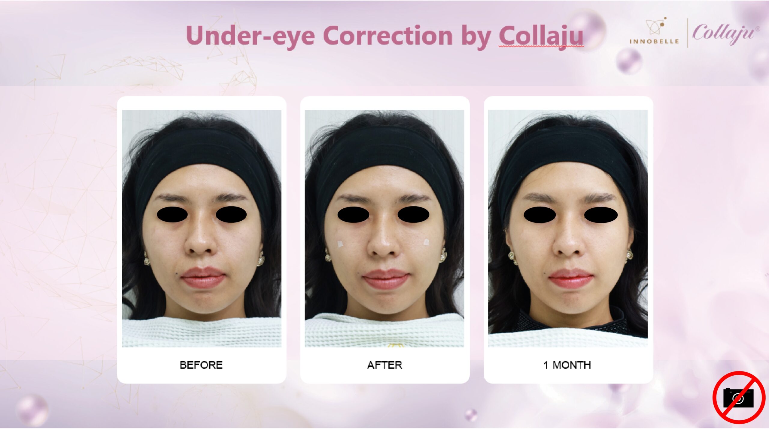 Under-eye Correction Before After 1 Month