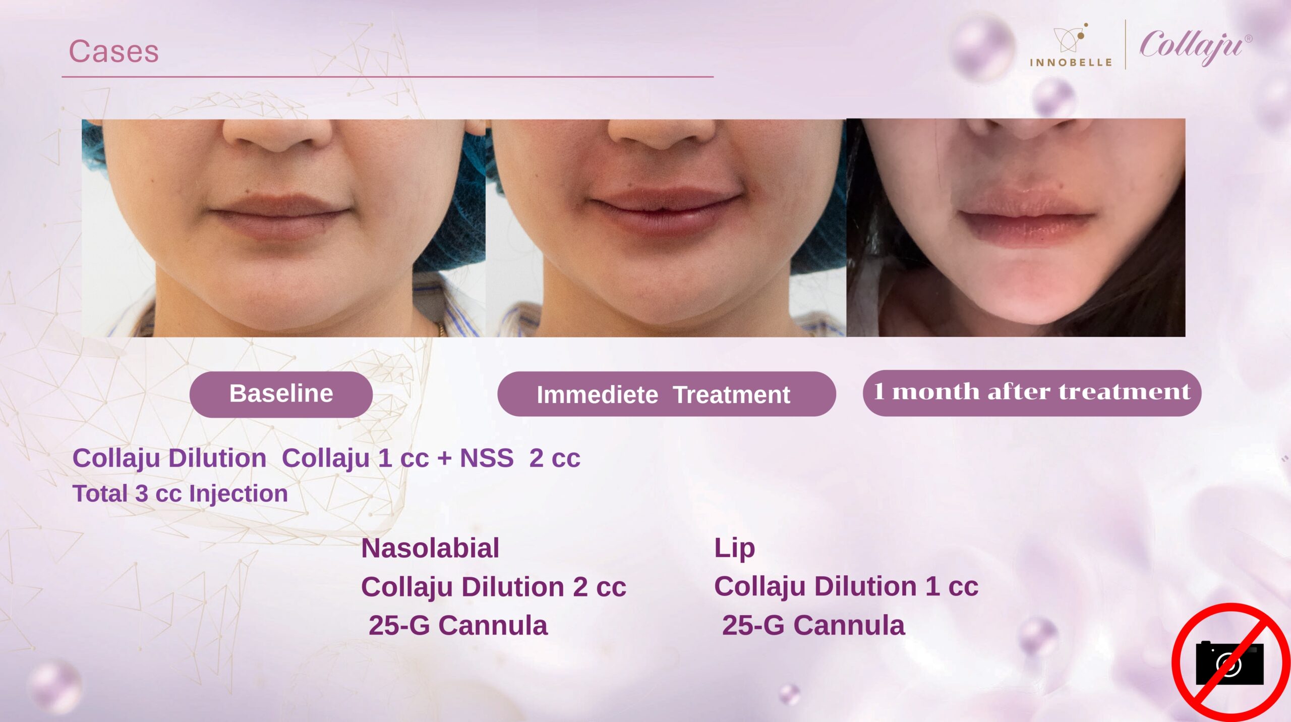 Hand Dorsum Before After