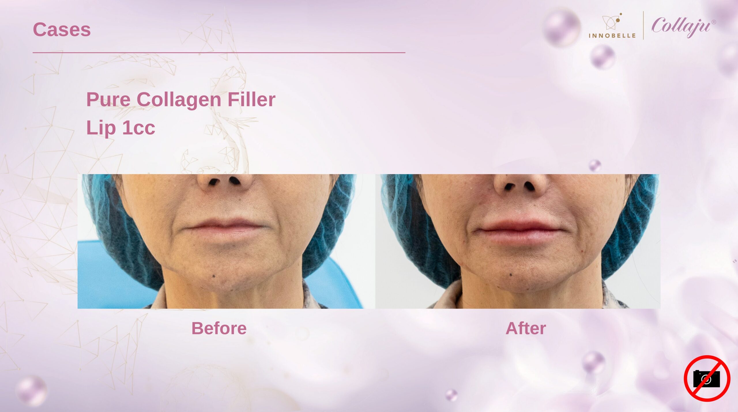 Lip Pure Collagen Filler Before After