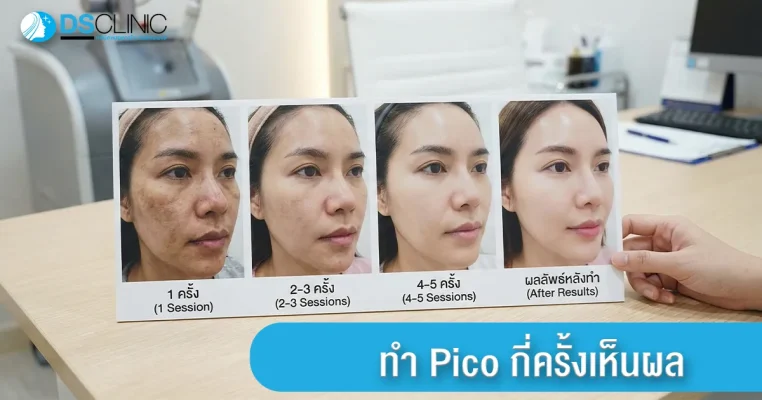 ภาพเปรียบเทียบผลลัพธ์การทำ Pico Laser ตั้งแต่ครั้งที่ 1 ไปจนถึงหลังทำครบ 5 ครั้ง เพื่อรักษาฝ้า กระ และจุดด่างดำ