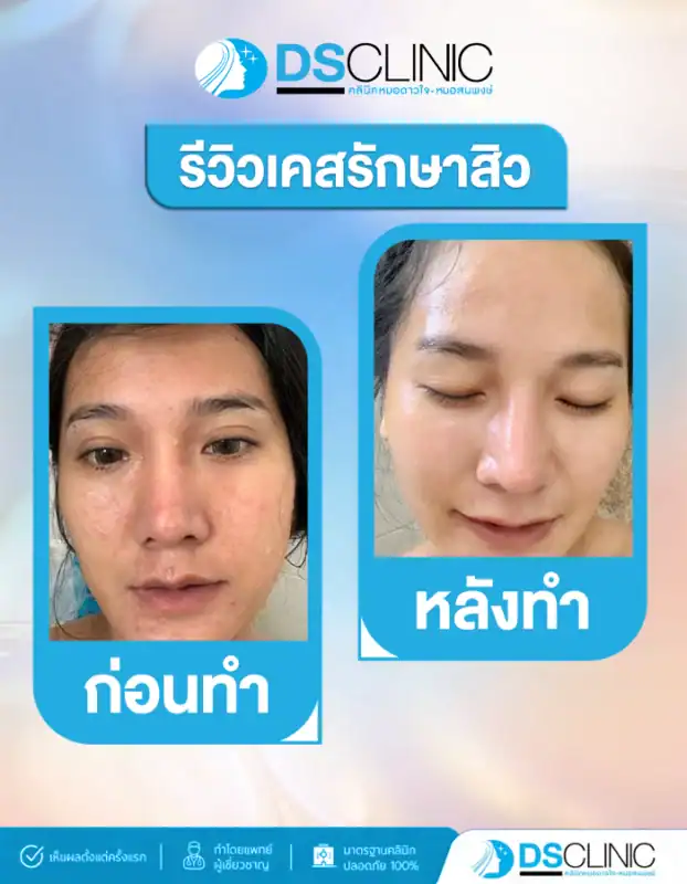 รีวิวเคสรักษาสิว เปลี่ยนผิวพังเป็นผิวปังที่ DS Clinic.