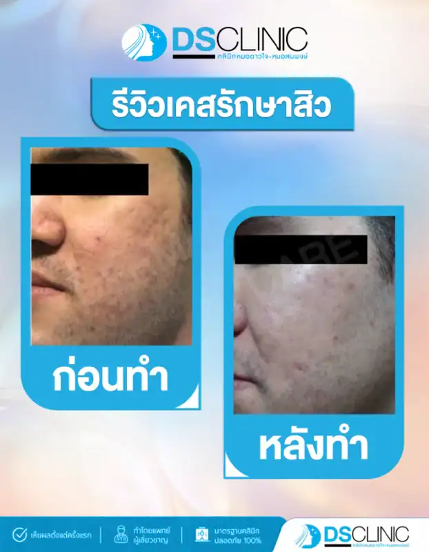 รีวิวรักษาสิวและหลุมสิวสำหรับผู้ชาย ช่วยปรับสภาพผิวให้สม่ำเสมอและลดการอักเสบ
