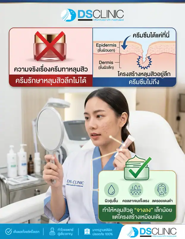 อธิบายความจริงเรื่องครีมทาหลุมสิวที่ไม่สามารถรักษาพังผืดในชั้นผิวลึกได้ แต่ช่วยให้รอยจางลง