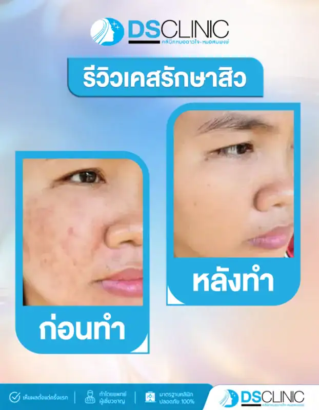 ภาพเปรียบเทียบก่อนและหลังรักษาสิว เผยผิวขาวกระจ่างใส ไร้รอยดำจากสิว