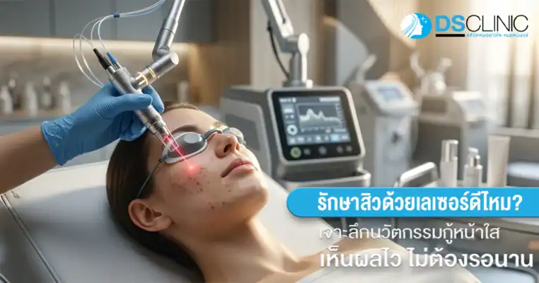 เลเซอร์รักษาสิวดีไหม? เจาะลึกนวัตกรรมเลเซอร์ช่วยรักษาสิว รอยแดง และรอยดำให้หายไว โดย DS Clinic