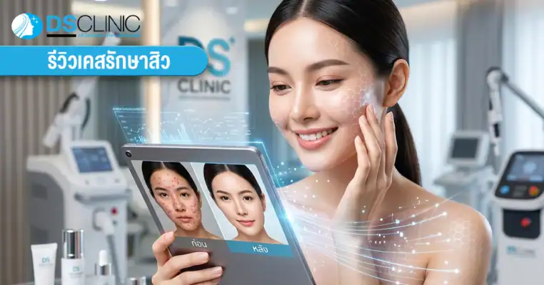 รีวิวรักษาสิว DS Clinic แสดงภาพเปรียบเทียบก่อนและหลัง