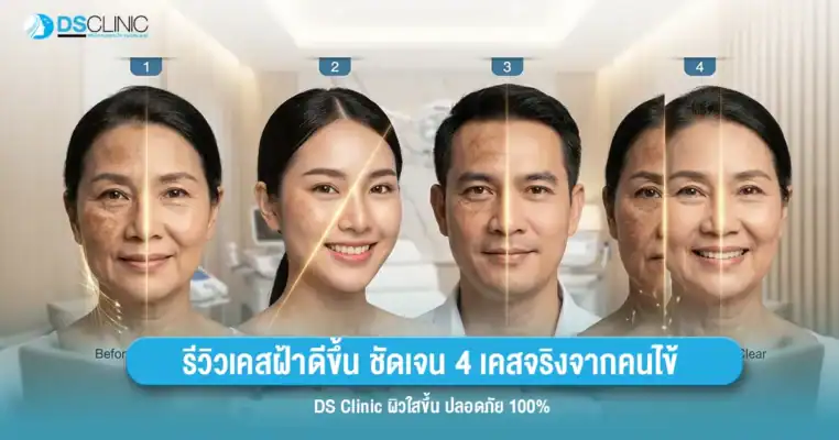 รีวิวเคสรักษาฝ้า 4 เคสจริงจากคนไข้ DS Clinic เผยผิวใสขึ้นอย่างปลอดภัย 100%