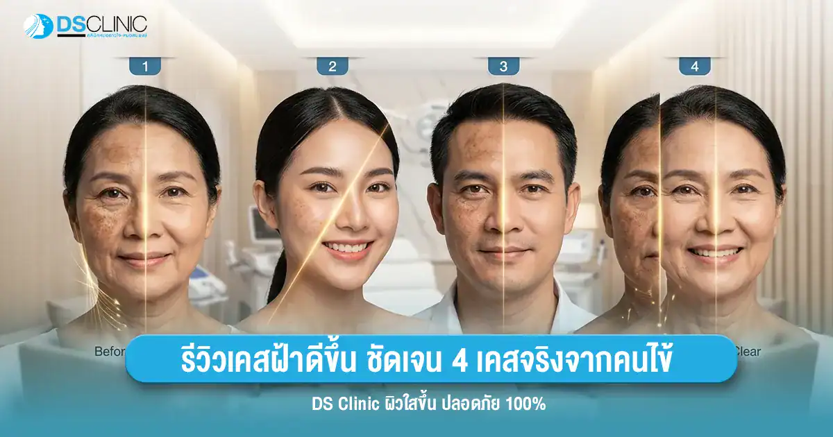 รีวิวเคสรักษาฝ้า 4 เคสจริงจากคนไข้ DS Clinic เผยผิวใสขึ้นอย่างปลอดภัย 100%