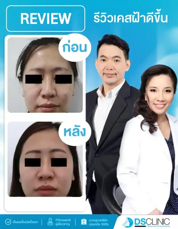 ภาพเปรียบเทียบก่อนและหลังการรักษาฝ้าและปรับสภาพผิวหน้าของ DS Clinic เผยให้เห็นรอยหมองคล้ำและจุดด่างดำที่จางลง ผิวดูกระจ่างใสและเรียบเนียนขึ้นอย่างชัดหลังเข้ารับการรักษา