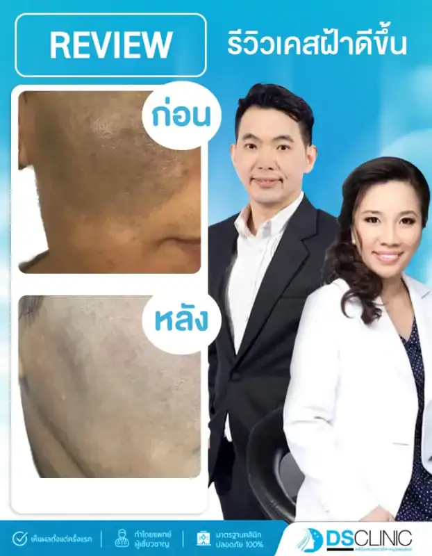 ภาพซูมเคสรีวิวการรักษาฝ้าแผ่นหนาบริเวณแก้มของ DS Clinic แสดงภาพก่อนทำที่มีปื้นฝ้าสีเข้มชัดเจน และภาพหลังทำที่รอยฝ้าดูจางลงอย่างมากจนสีผิวกลับมาใกล้เคียงปกติ