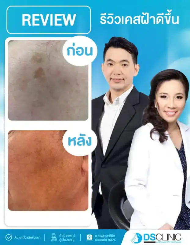 ภาพรีวิวผลลัพธ์การรักษาฝ้าและจุดด่างดำสะสมของ DS Clinic เปรียบเทียบผิวก่อนและหลังทำ โดยรอยฝ้าแดดและจุดกระฝังลึกดูจางลง ผิวดูสม่ำเสมอขึ้น การันตีทำโดยแพทย์ผู้เชี่ยวชาญ ปลอดภัย 100%