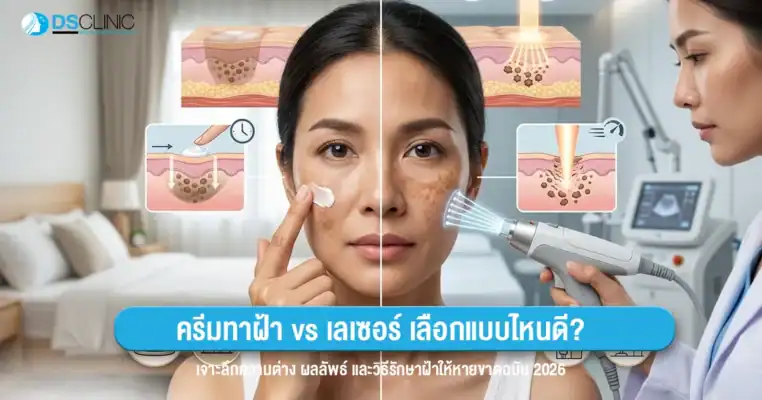 ภาพเปรียบเทียบการรักษาฝ้าด้วยครีมทาฝ้าและการทำเลเซอร์ โดยฝั่งซ้ายแสดงการใช้ครีมบำรุงผิวที่ซึมเข้าสู่ชั้นผิว และฝั่งขวาแสดงการใช้เครื่องเลเซอร์ยิงพลังงานเพื่อสลายเม็ดสีใต้ผิวหนัง