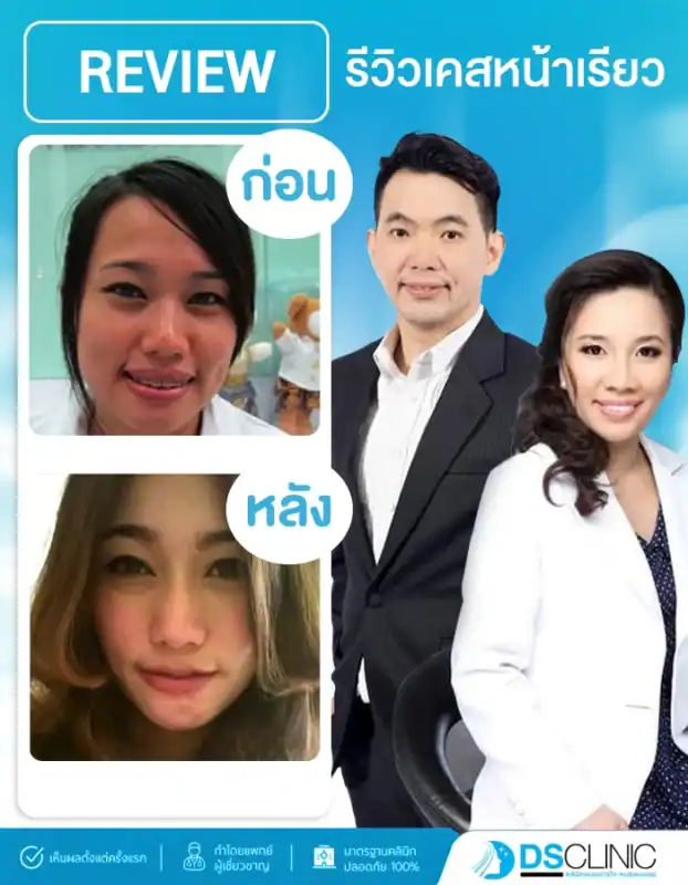 รีวิวเคสหน้าเรียว ปรับรูปหน้าเปลี่ยนหน้ากลมเป็น V-Shape ชัดเจน ที่ DS Clinic