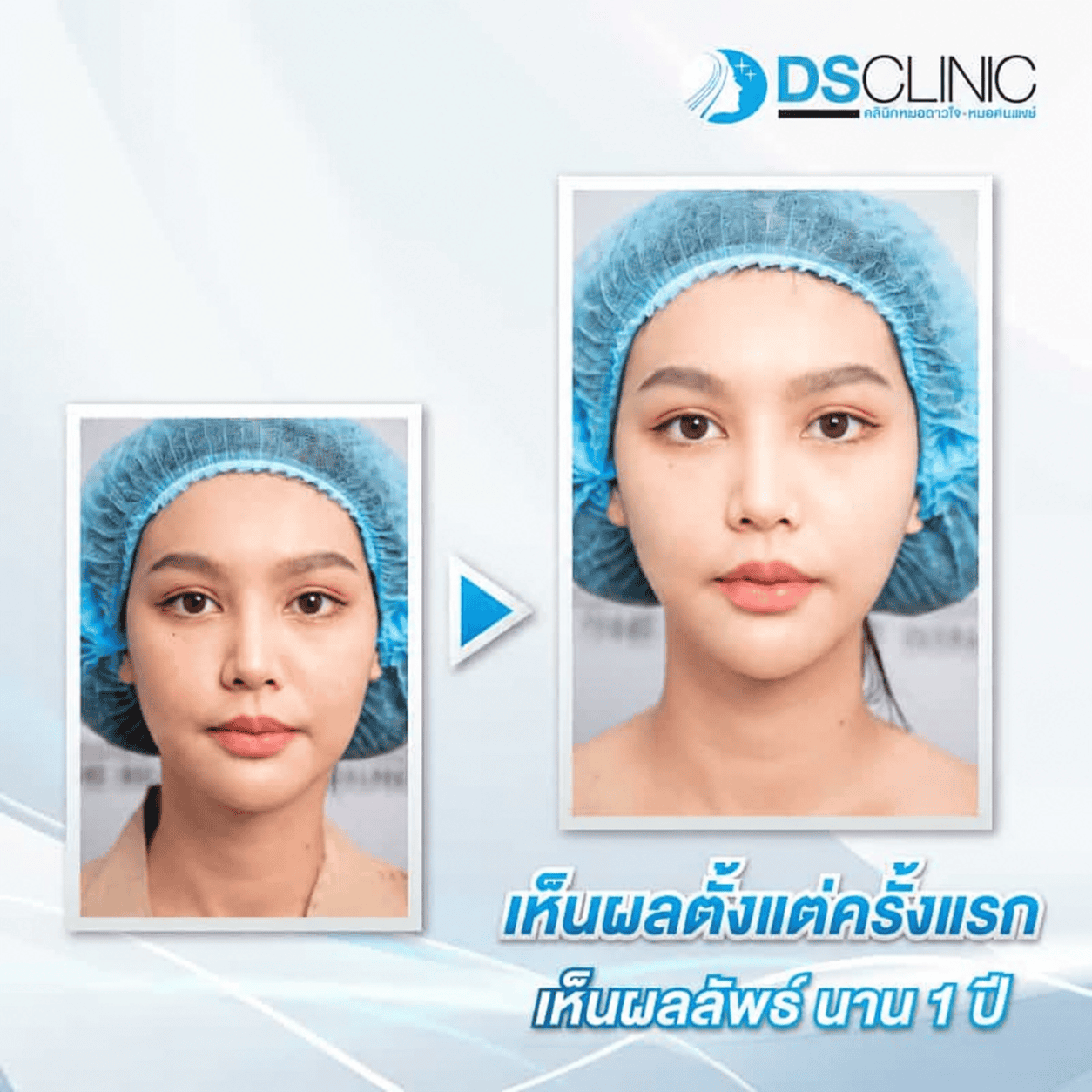 รีวิว Ultherapy ก่อนและหลังทำ ที่ DS Clinic อุดรธานี