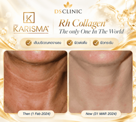 KARISMA Rh Collagen Neck Transformation