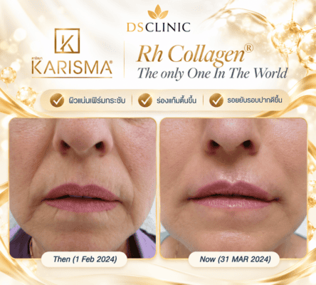 Karisma Rh Collagen 